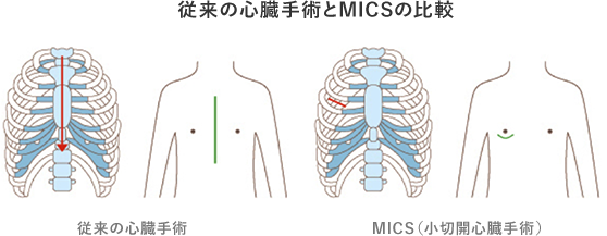従来の心臓手術とMICSの比較イメージ図