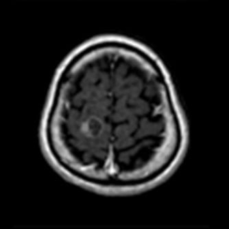 症例1 頭部MRI