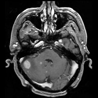 症例1 頭部MRI