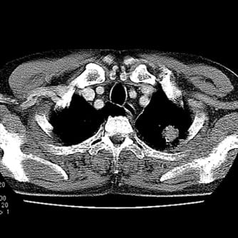 症例2 胸部CT