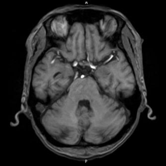 症例2 頭部MRI