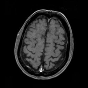 症例2 頭部MRI