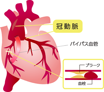 心拍動下冠動脈バイパス術のイメージ図1