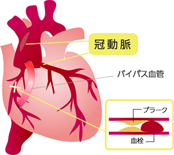 心拍動下冠動脈バイパス術 | 済生会熊本病院 心臓血管センター