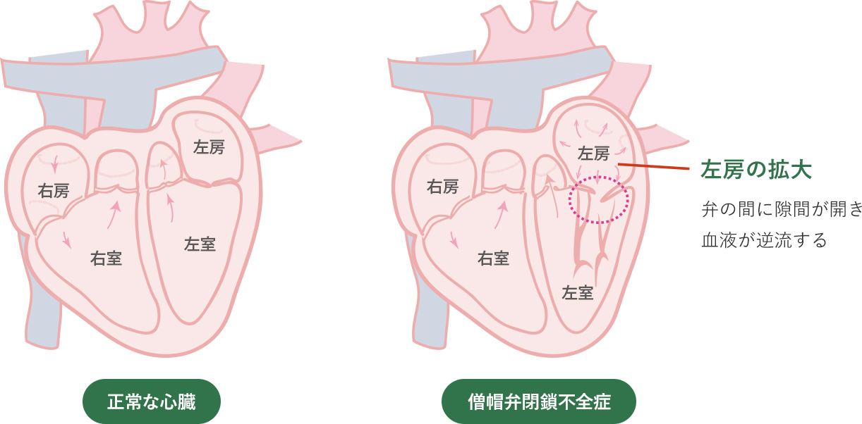 僧帽弁逸脱に関するよくある質問