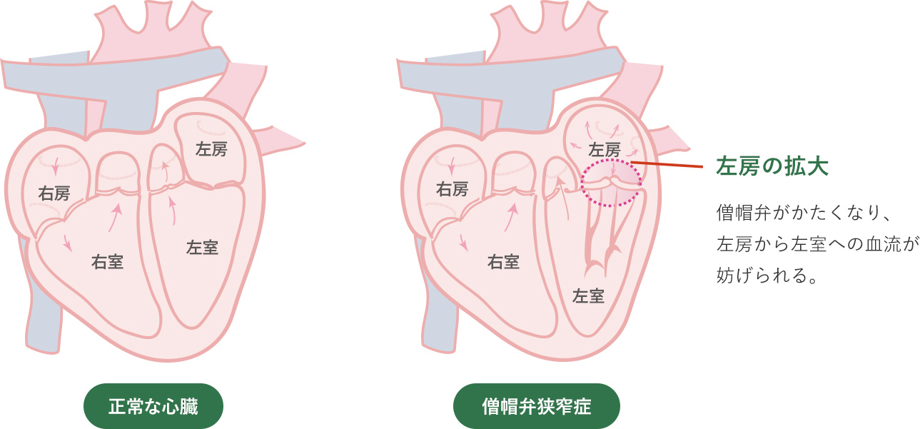 大動脈弁狭窄症の雑音はどのような音ですか?