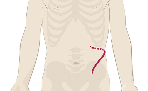 従来の開腹手術における切開部
