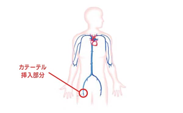 鼠径部（太ももの付け根）の大静脈からカテーテルを通して、 AMPLATZER™ PFOオクルーダーを心臓に挿入します。