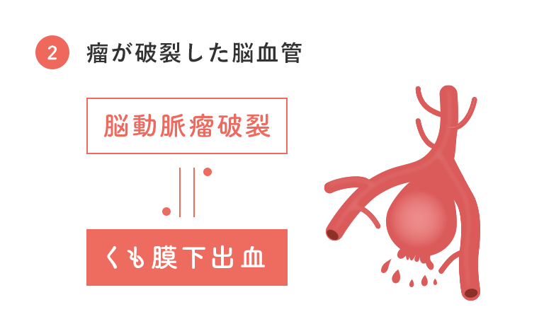 動脈瘤とは何ですか?