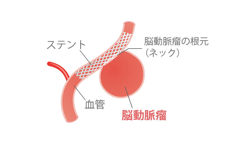 フローダイバーター留置術（血管内治療）治療法イラスト