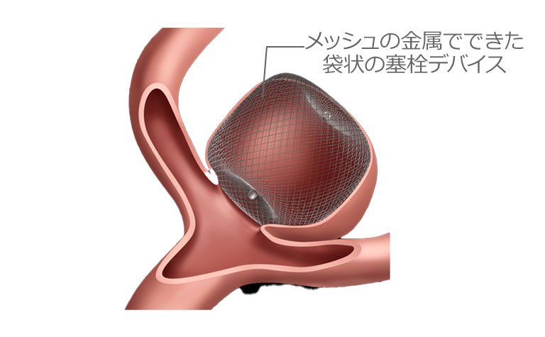 Woven EndoBridge デバイス治療（血管内治療）治療法イラスト