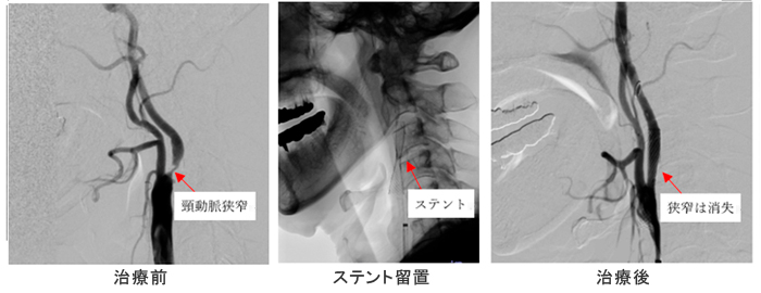 頸部ステント留置術（CAS）