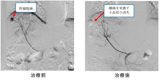 経カテーテル肝動脈化学塞栓術