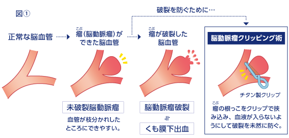 脳動脈瘤クリッピング術 ― くも膜下出血を未然に防ぐ 未破裂脳動脈瘤 ...