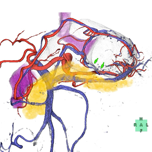 ロボットによる胃がん手術時に作成した3D画像