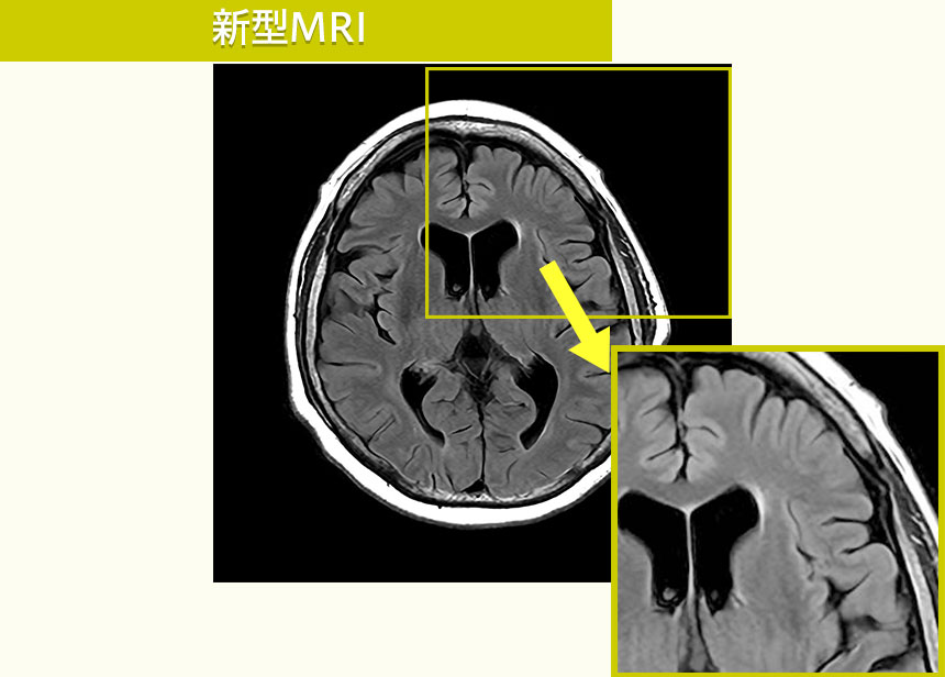 より高画質に 新型MRI