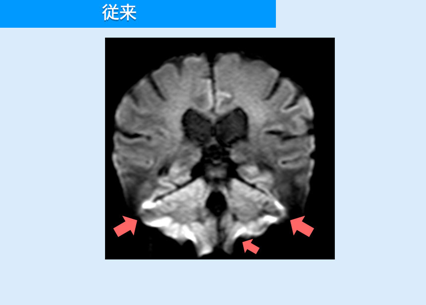 歪みなく(従来)