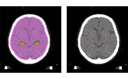 転移性脳腫瘍の放射線治療｜海馬回避全脳照射（HA-WBRT）で認知機能を守る