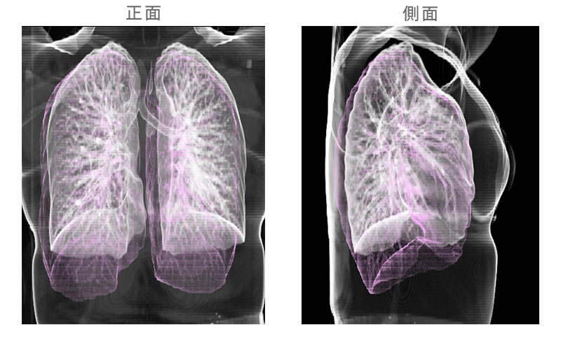 立位と臥位で撮影比較