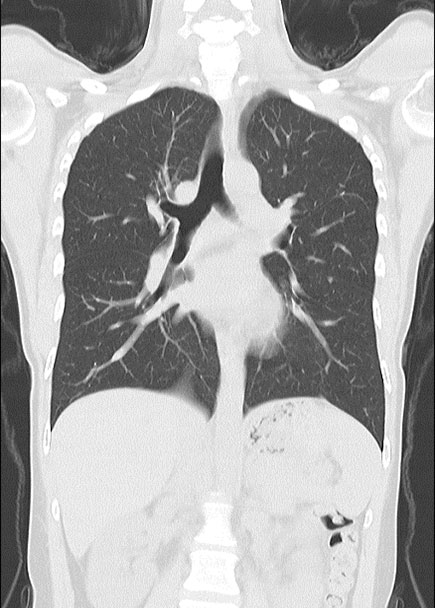 臥位で撮影した肺CT