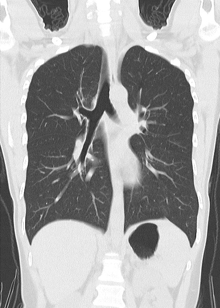 立位で撮影した肺CT
