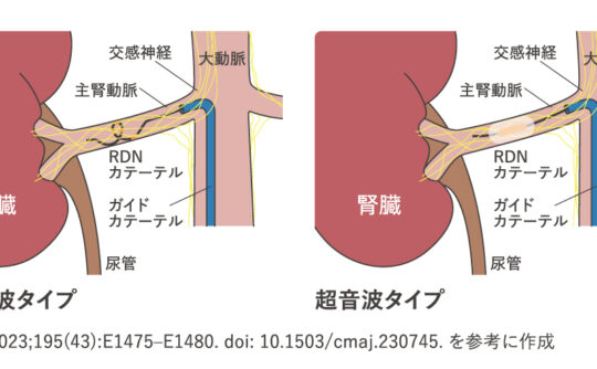 血圧がなかなか下がらない方へ-新しい治療「腎デナベーション」を導入しました-