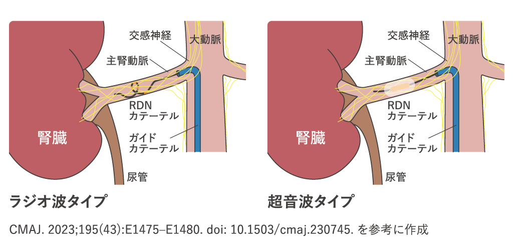 腎デナベーション治療の流れ